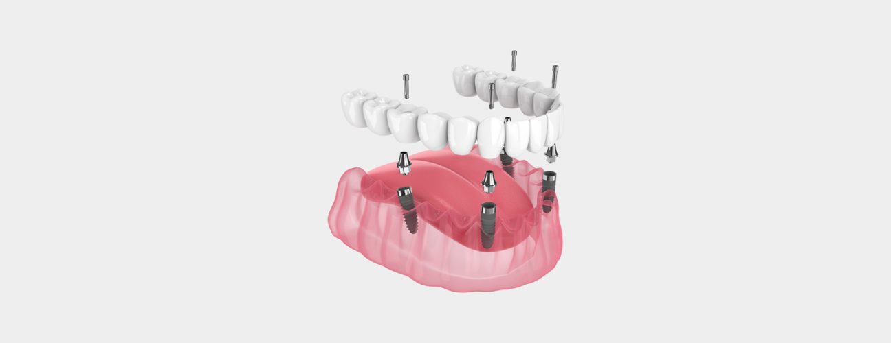 Preparing for Your Fixed Full Arch Procedure