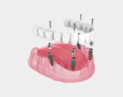 Preparing for Your Fixed Full Arch Procedure